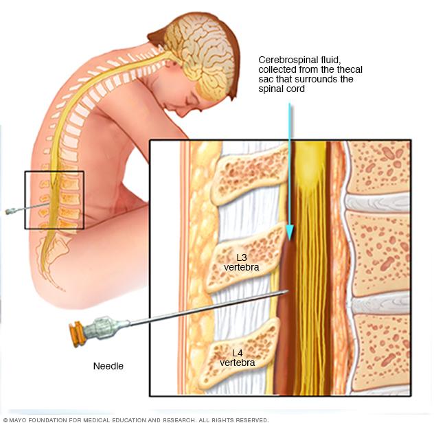 Lumbar puncture, also called a spinal tap
